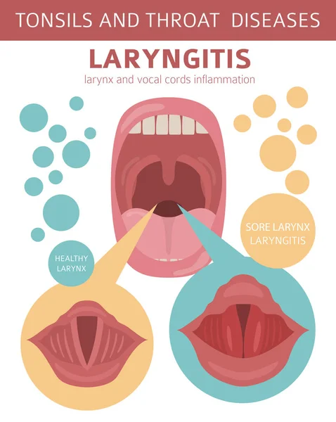 Amígdalas Enfermedades Garganta Síntomas Laringitis Conjunto Iconos Tratamiento Diseño Infografía — Vector de stock