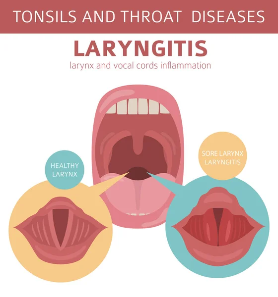 Tonsilas Doenças Garganta Sintomas Laringite Conjunto Ícone Tratamento Projeto Infográfico — Vetor de Stock