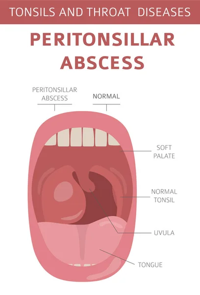 Миндалины Заболевания Горла Симптомы Перитонзиллярного Абсцесса Набор Значков Лечения Медицинский — стоковый вектор