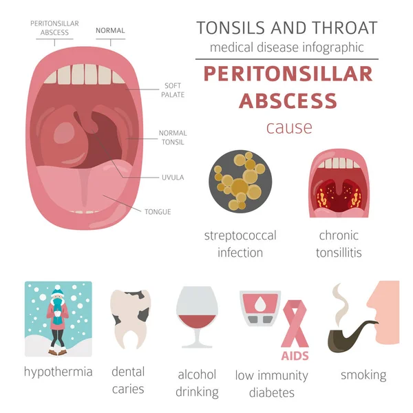 扁桃体和咽喉疾病 腹膜脓肿症状 治疗图标集 医疗信息图设计 向量例证 — 图库矢量图片