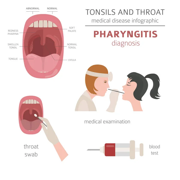 Tonsils Throat Diseases Pharyngitis Symptoms Treatment Icon Set Medical Infographic — Stock Vector