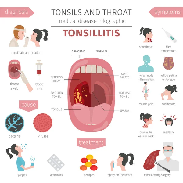 Mandulák Torokban Betegségek Mandulagyulladás Tünetek Kezelés Ikon Készlet Orvosi Infographic — Stock Vector