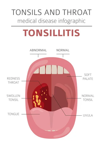 Tonsilas Doenças Garganta Sintomas Amigdalite Conjunto Ícones Tratamento Projeto Infográfico —  Vetores de Stock