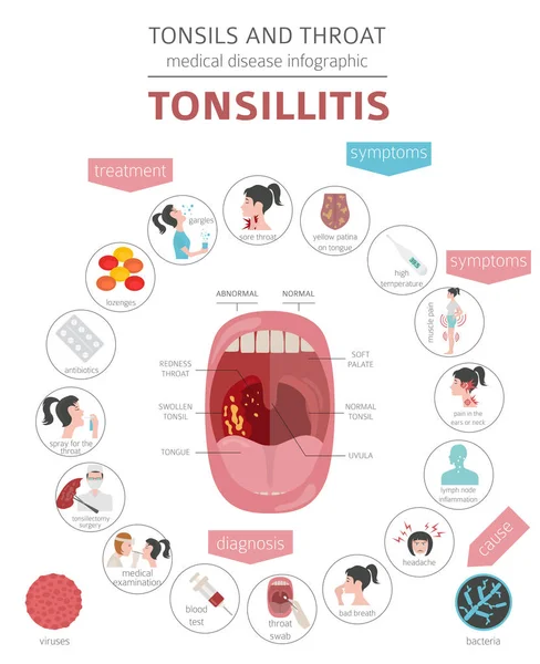 Amígdalas Enfermedades Garganta Síntomas Amigdalitis Conjunto Iconos Tratamiento Diseño Infografía — Vector de stock