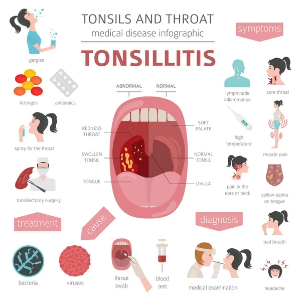 Amígdalas Enfermedades Garganta Síntomas Amigdalitis Conjunto Iconos Tratamiento Diseño Infografía — Vector de stock