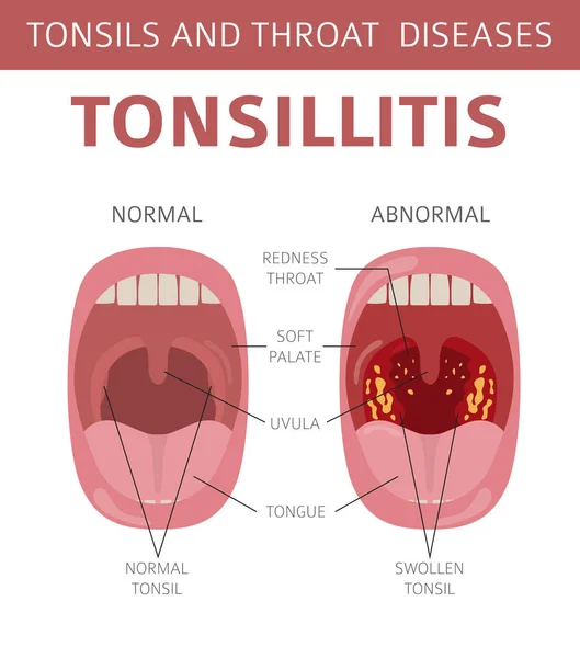 46 Normal Tonsil Vector Images Normal Tonsil Illustrations Depositphotos
