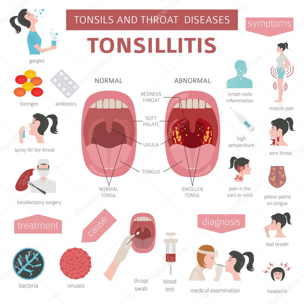 Tonsils and throat diseases. Tonsillitis symptoms, treatment icon set. Medical infographic design. Vector illustration