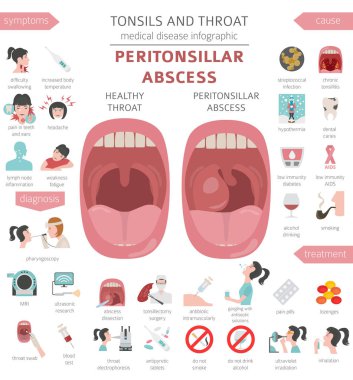 Bademcik ve boğaz hastalıkları. Peritonsiller apse belirtiler, tedavi Icon set. Tıbbi Infographic tasarım. Vektör çizim