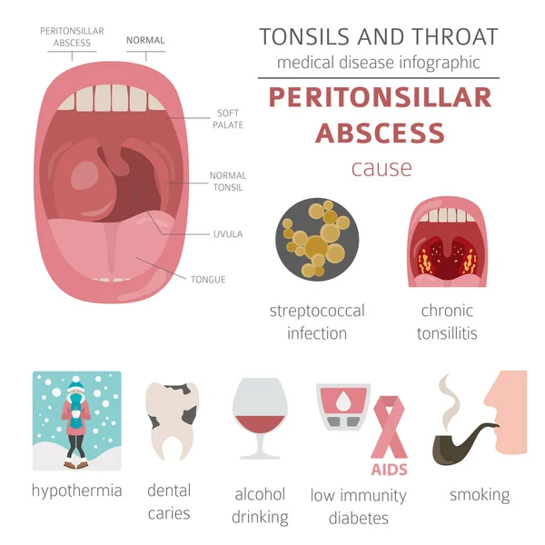 Tonsilas Doenças Garganta Sintomas Abscesso Peritonsilar Conjunto Ícones Tratamento Projeto — Vetor de Stock