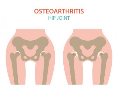 Artrit, osteoartrit tıbbi infografik tasarım. Ortak repl