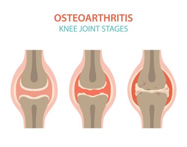Artrit, osteoartrit tıbbi infografik tasarım. Ortak repl