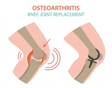 Artrit, osteoartrit tıbbi infografik tasarım. Ortak repl