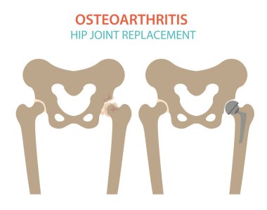 Artrit, osteoartrit tıbbi infografik tasarım. Ortak repl