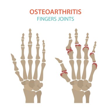 Artrit, osteoartrit tıbbi infografik tasarım. Ortak repl