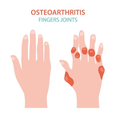 Artrit, osteoartrit tıbbi infografik tasarım. Ortak repl