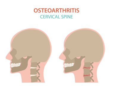 Artrit, osteoartrit tıbbi infografik tasarım. Ortak repl