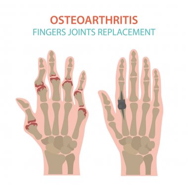 Artrit, osteoartrit tıbbi infografik tasarım. Ortak repl