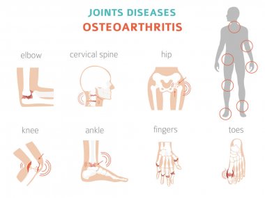 Artrit, osteoartrit tıbbi infografik tasarım. Ortak repl