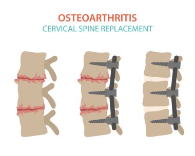 Artrit, osteoartrit tıbbi infografik tasarım. Ortak repl
