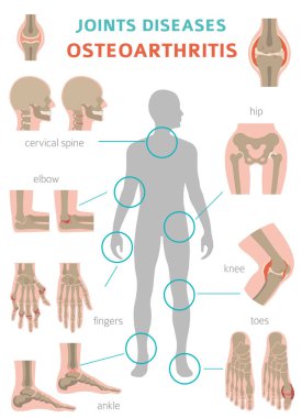 Artrit, osteoartrit tıbbi infografik tasarım. Ortak repl