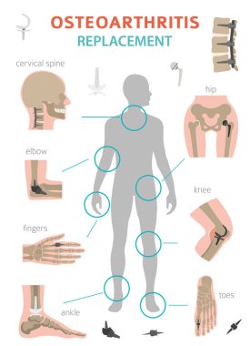 Artrit, osteoartrit tıbbi infografik tasarım. Ortak repl
