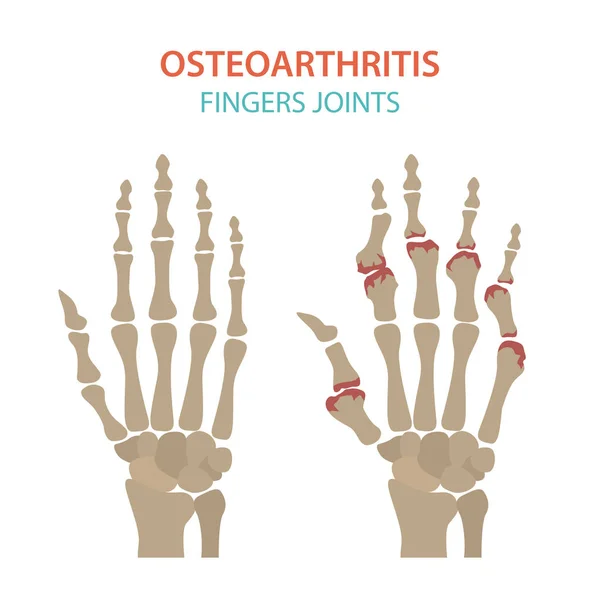 Artritis, osteoartritis diseño médico infográfico. Repl conjunto — Vector de stock
