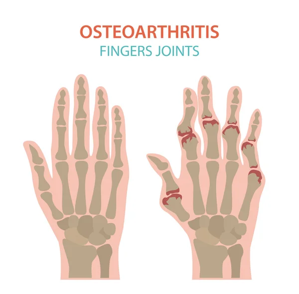 Arthritis, Arthrose medizinische Infografik Design. Joint repl — Stockvektor