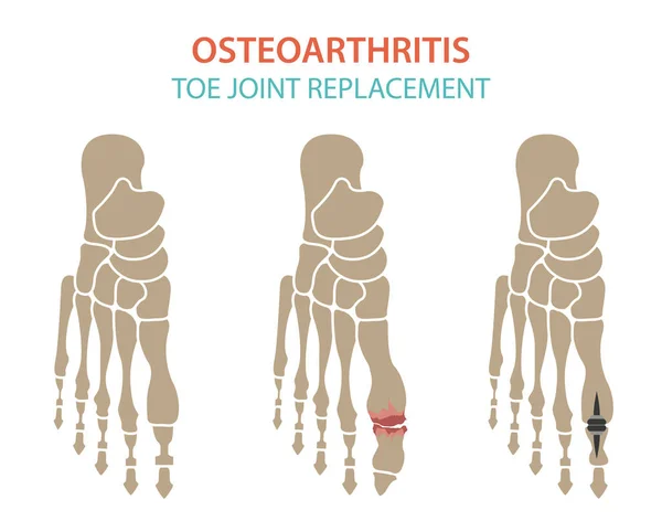 Arthritis, osteoarthritis desain infografis medis. Repl bersama - Stok Vektor