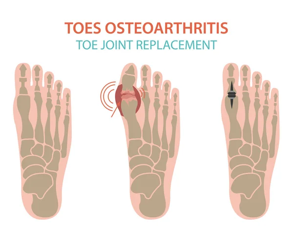 Arthritis, osteoarthritis desain infografis medis. Repl bersama - Stok Vektor