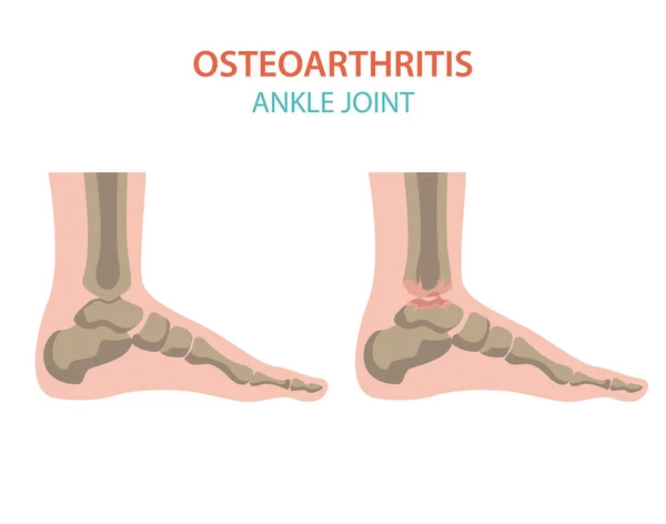 Artrit, osteoartrit tıbbi infografik tasarım. Ortak repl — Stok Vektör