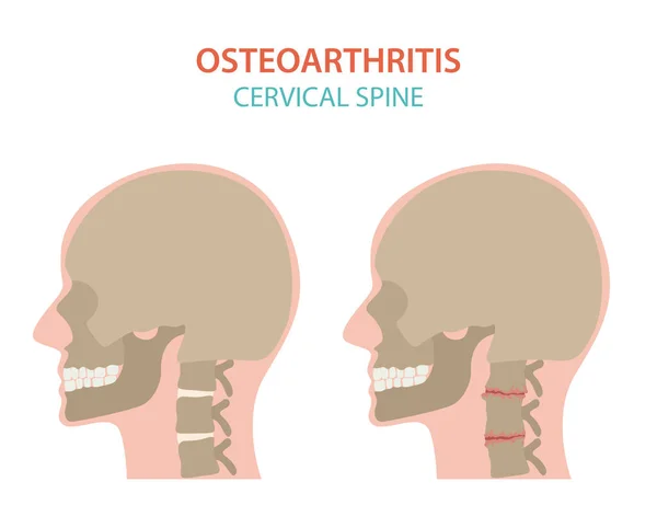 Artrite, osteoartrite progettazione infografica medica. Relazione comune n. — Vettoriale Stock