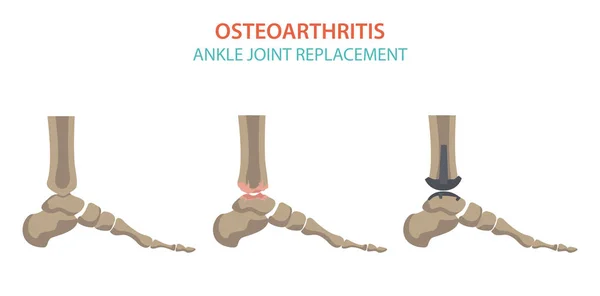 Artrite, osteoartrite progettazione infografica medica. Relazione comune n. — Vettoriale Stock