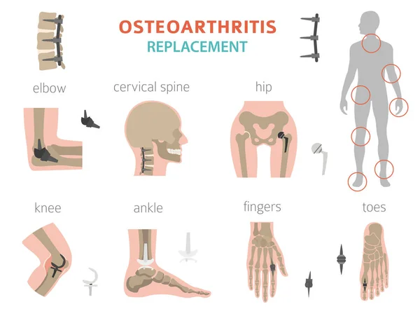 Arthritis, osteoarthritis orvosi infographic design. Közös repl — Stock Vector