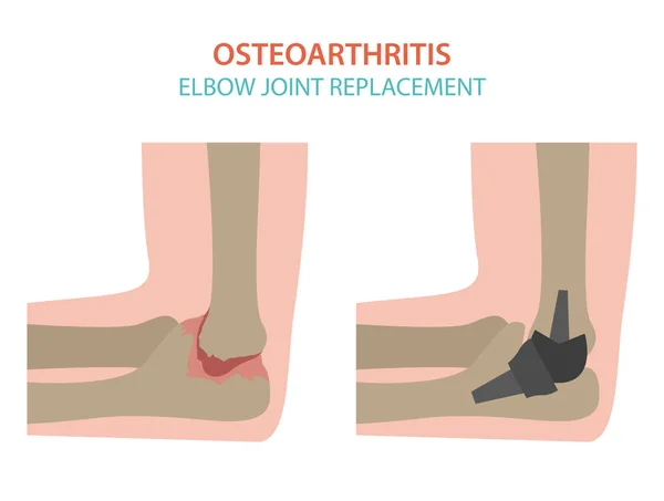 Arthritis, osteoarthritis desain infografis medis. Repl bersama - Stok Vektor