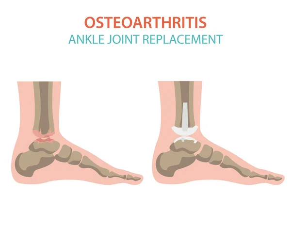 Arthritis, osteoarthritis desain infografis medis. Repl bersama - Stok Vektor