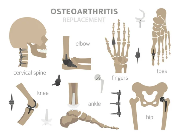 Artritis, osteoartritis diseño médico infográfico. Repl conjunto — Vector de stock