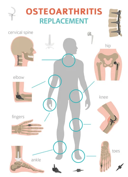 Arthritis, osteoarthritis desain infografis medis. Repl bersama - Stok Vektor