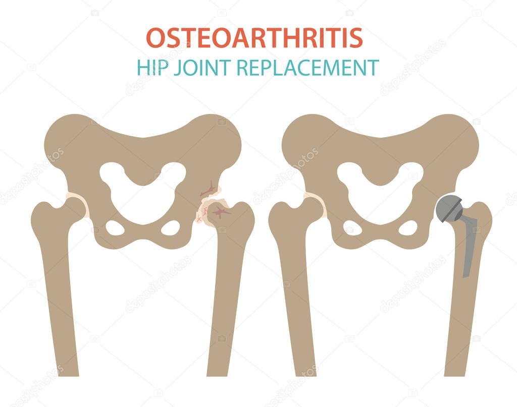 Arthritis, osteoarthritis medical infographic design. Joint repl