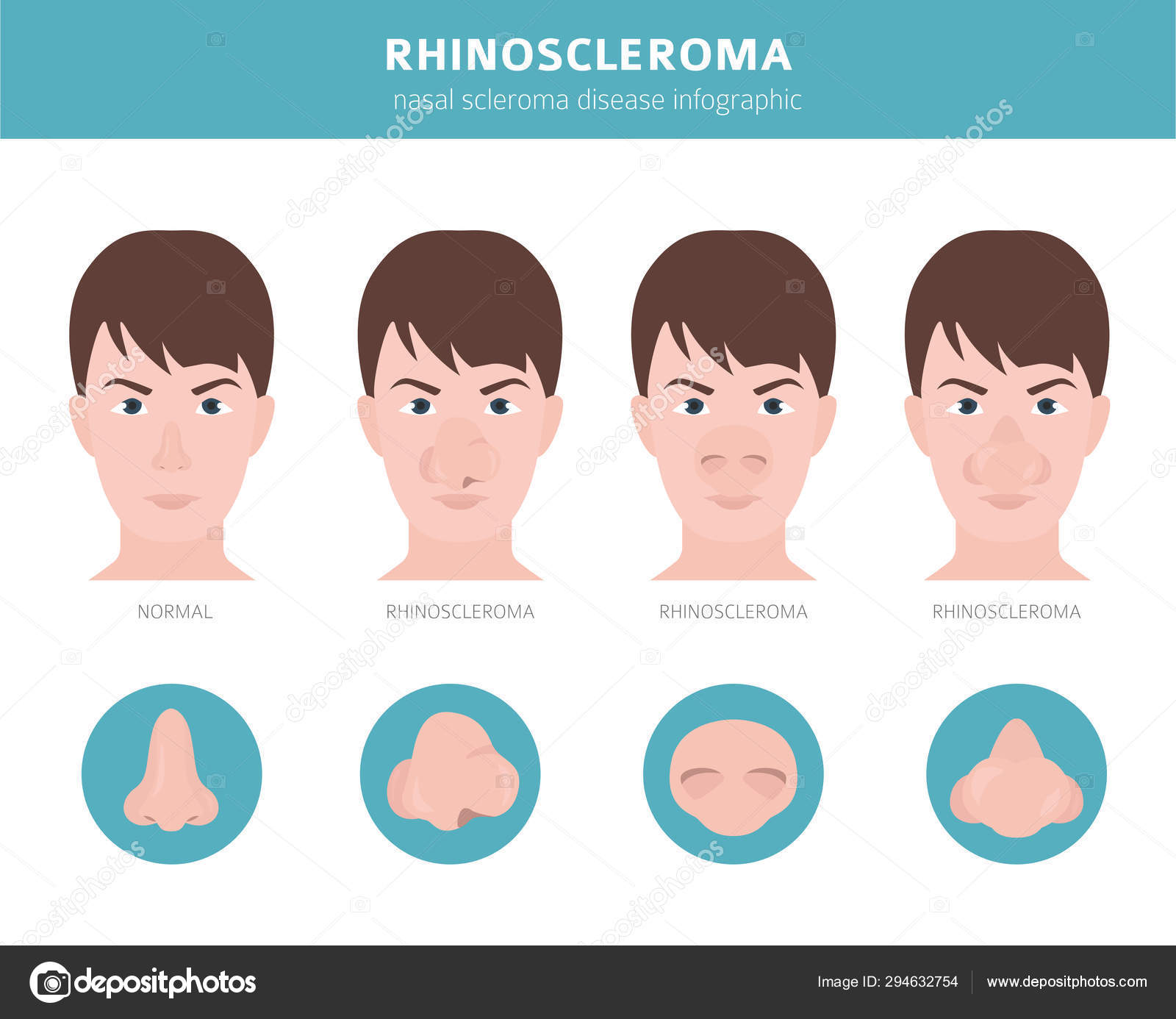 Риносклерома микропрепарат. Рино склеромная гранулема. Риносклерома. Риносклерома. Склеромная гранулема микропрепарат.