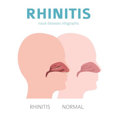 Burun hastalıkları. Rinit belirtileri, tedavi simgesi. Tıbbi i
