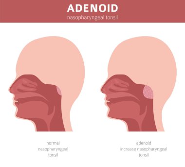 Burun ve boğaz, nazofanek hastalıkları. Adenoidler tanı ve t