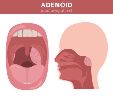 Nasal and throat, nasopharynx diseases. Adenoids diagnosis and t clipart