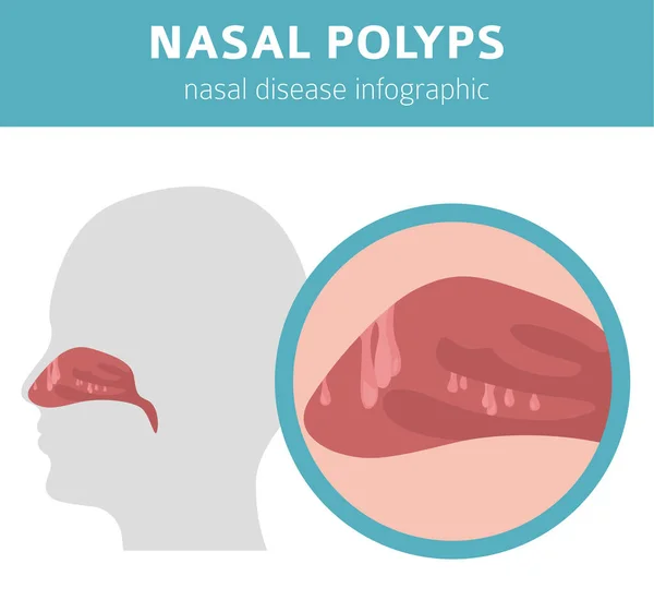 Doenças nasais. Pólipos nasais causas, diagnóstico e tratamento med —  Vetores de Stock