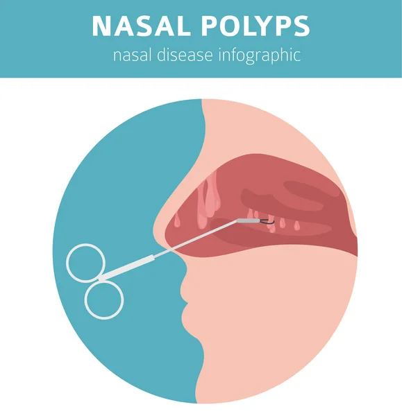 Enfermedades nasales. Pólipos nasales causas, diagnóstico y tratamiento med — Vector de stock