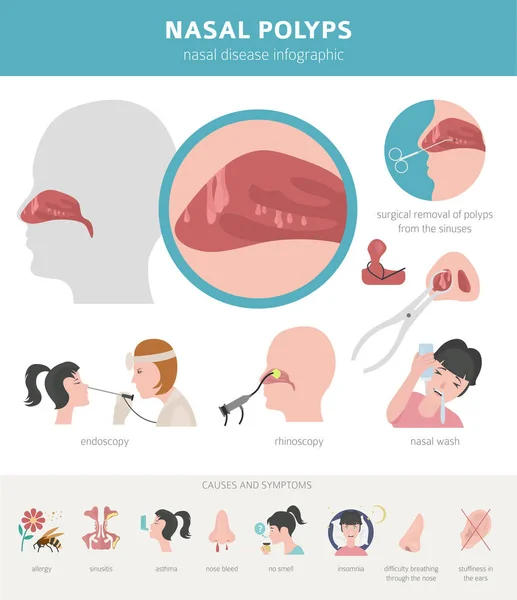 Носовые заболевания. Причины возникновения полипов носа, диагностика и лечение — стоковый вектор