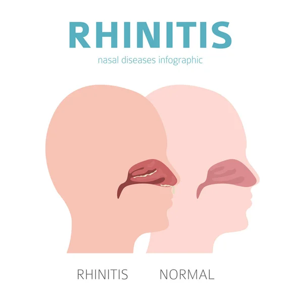 Doenças nasais. Sintomas de rinite, conjunto de ícone de tratamento. Médico i — Vetor de Stock