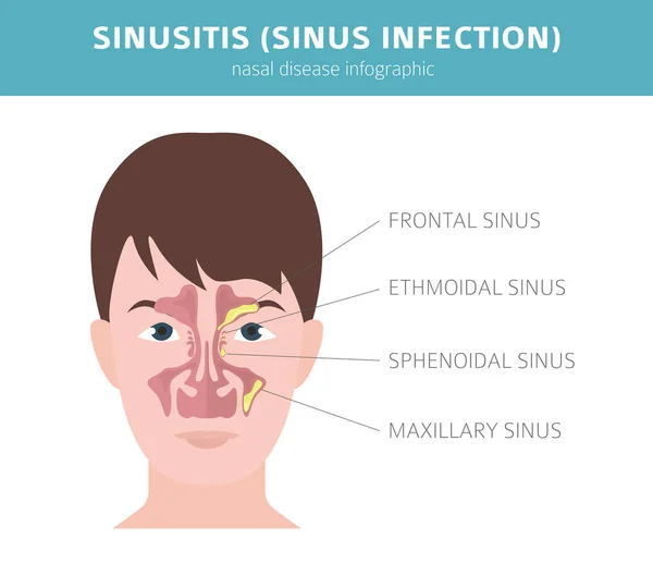 Doenças nasais. Sinusite, diagnóstico de infecção sinusal e tratamento —  Vetores de Stock