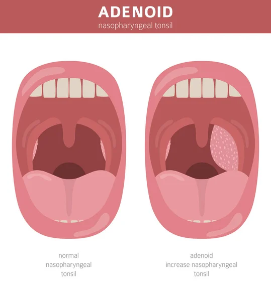 Носовое горло, носоглотки. Диагноз аденоидов и t — стоковый вектор