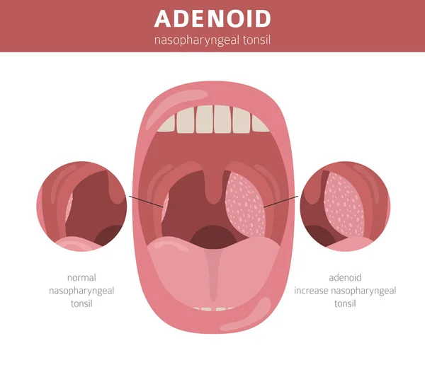 Nasal e garganta, doenças da nasofaringe. Diagnóstico de adenóides e t — Vetor de Stock