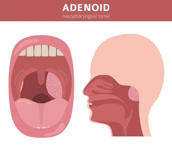 Nasal and throat, nasopharynx diseases. Adenoids diagnosis and t — Stock Vector